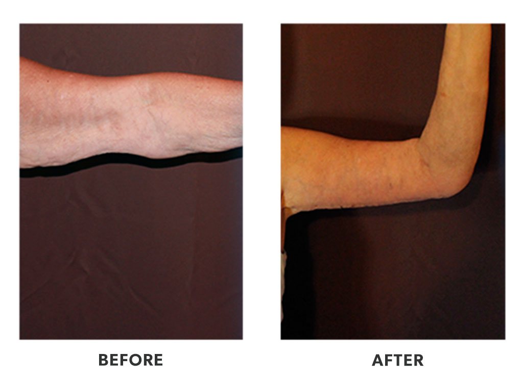 Before and after an armlift in Tijuana Mexico