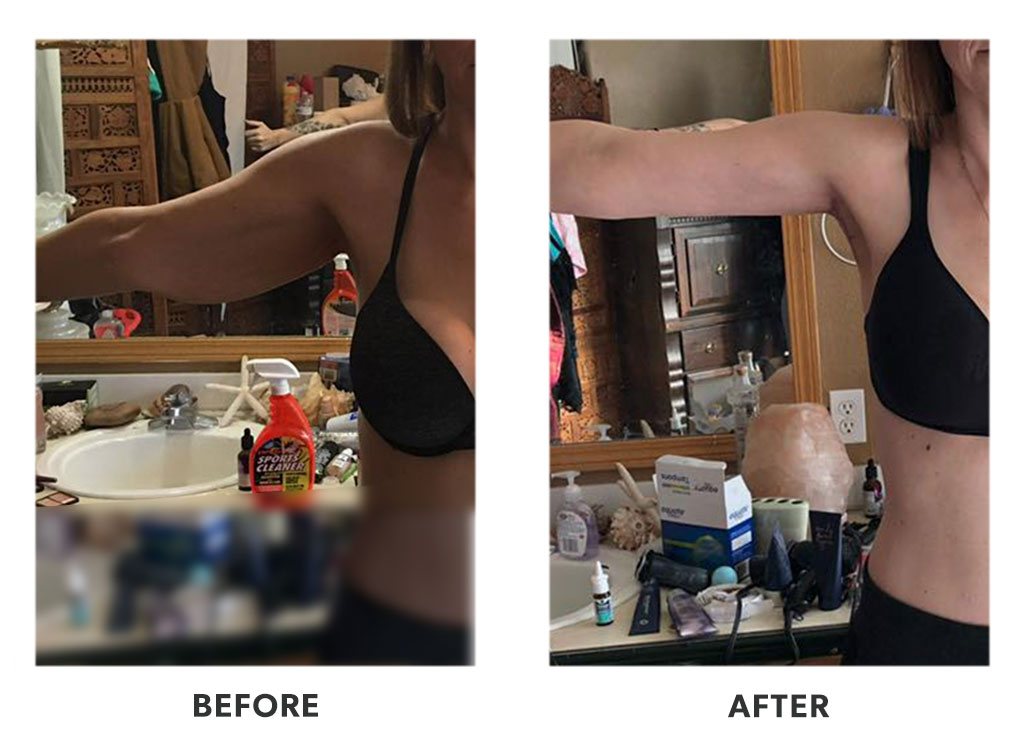 Before and after an armlift in Tijuana Mexico