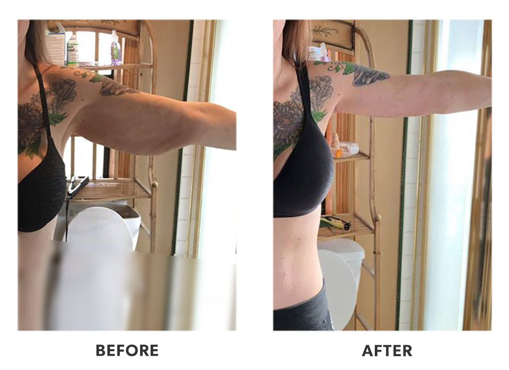 Before and after an armlift in Tijuana Mexico