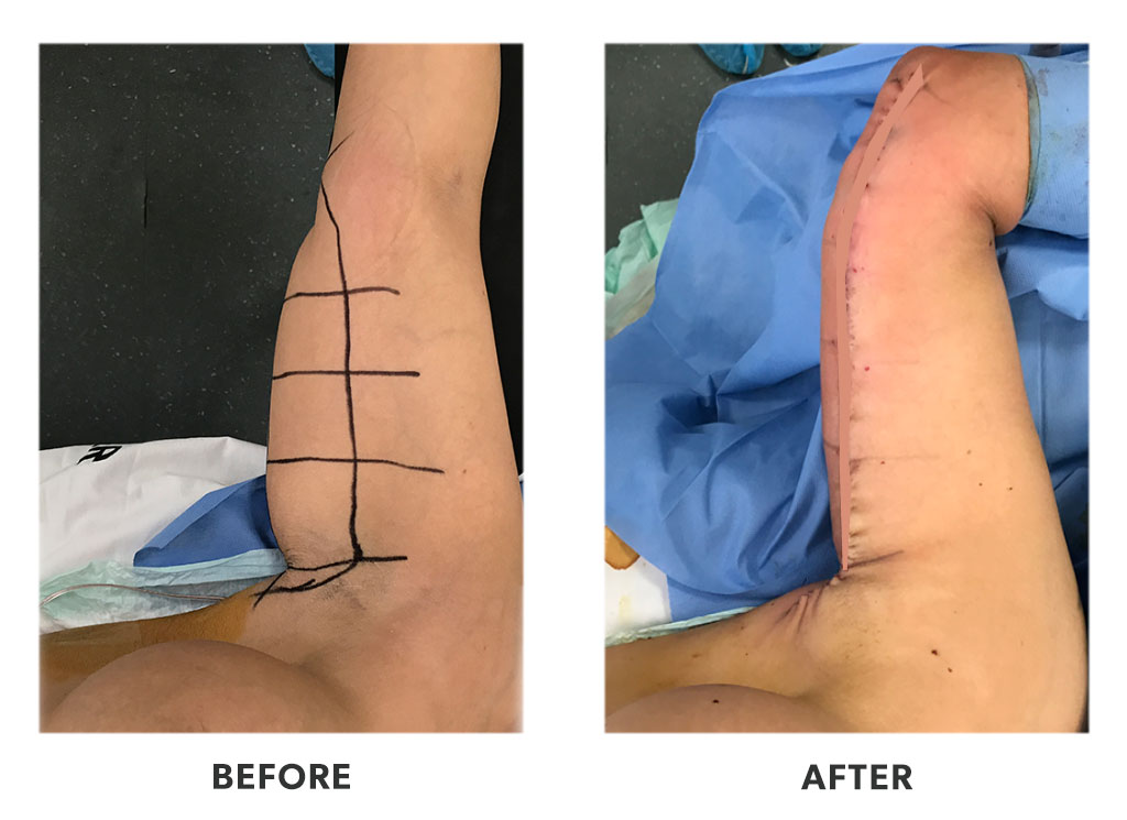 Before and after an armlift in Tijuana Mexico