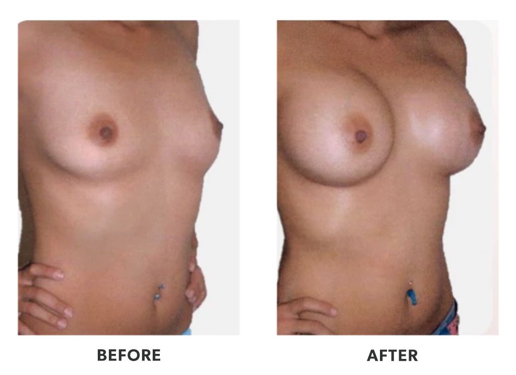 Before and after a breast augmentation in Tijuana Mexico