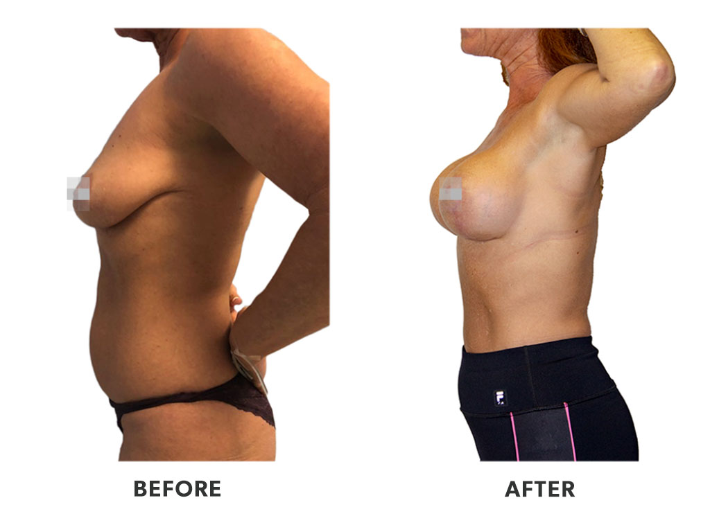 Before and after a breast augmentation in Tijuana Mexico