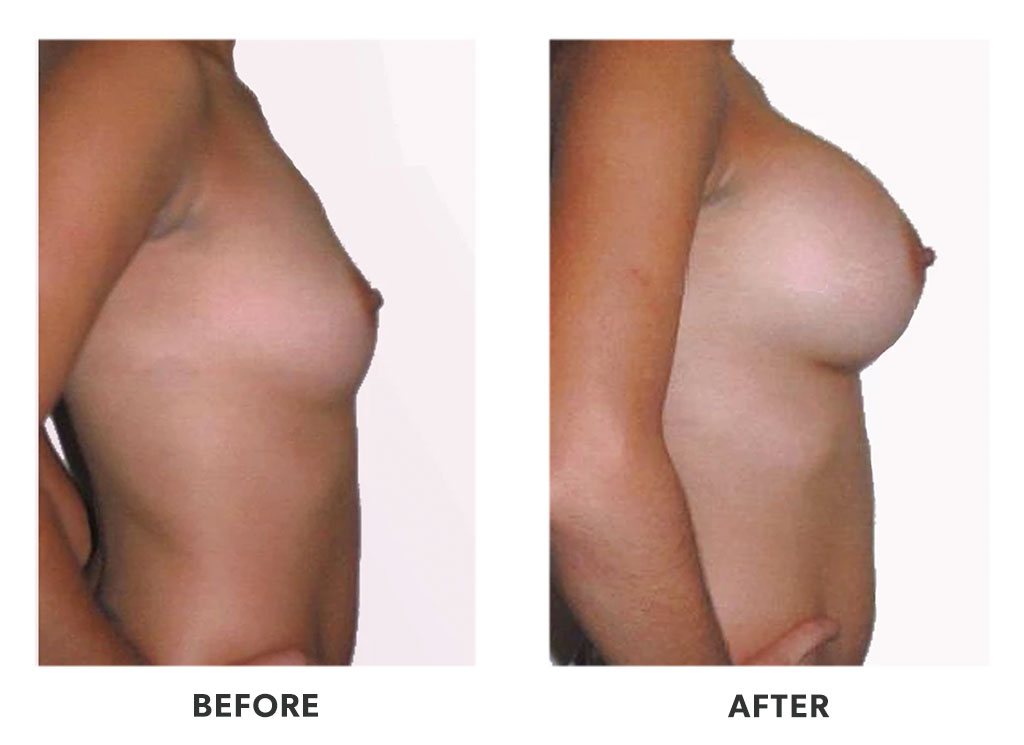 Before and after a breast augmentation in Tijuana Mexico