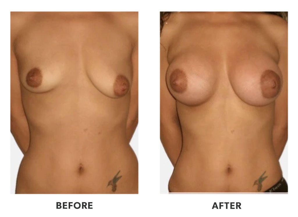 Before and after a breast augmentation in Tijuana Mexico