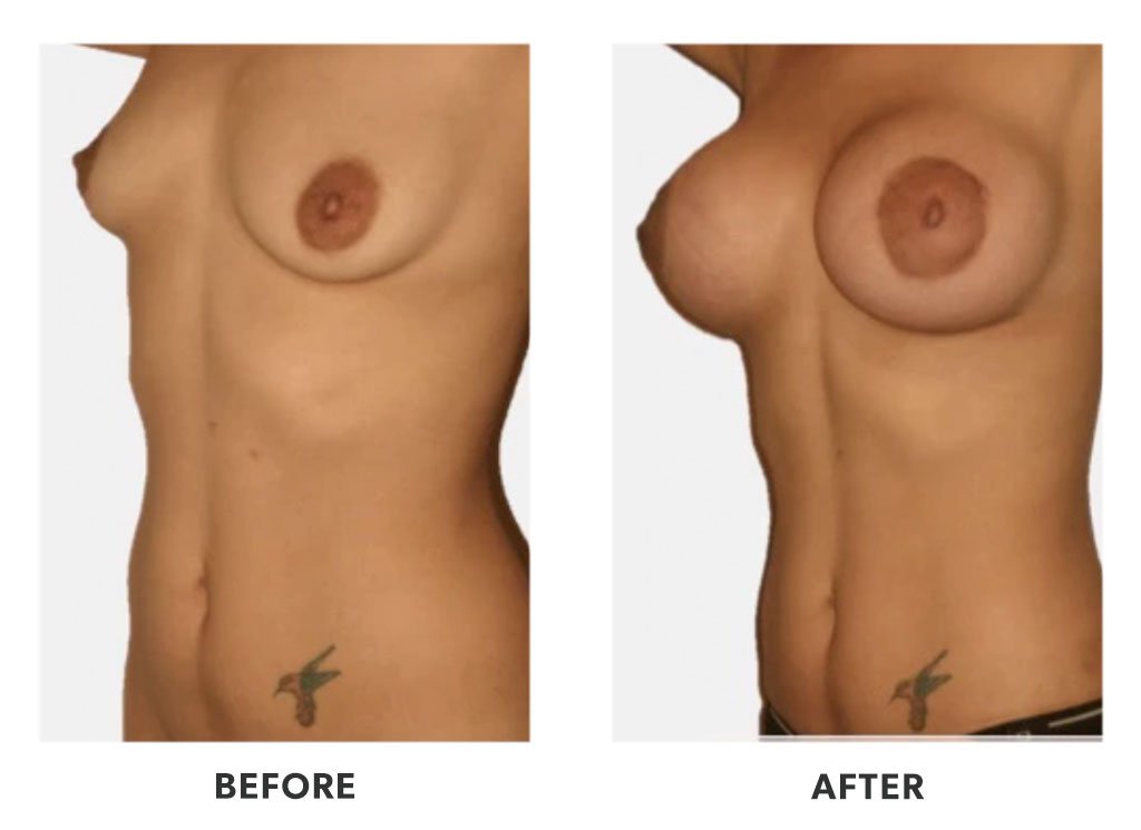 Before and after a breast augmentation in Tijuana Mexico