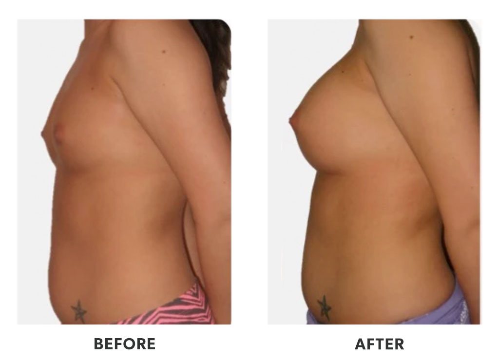 Before and after a breast augmentation in Tijuana Mexico