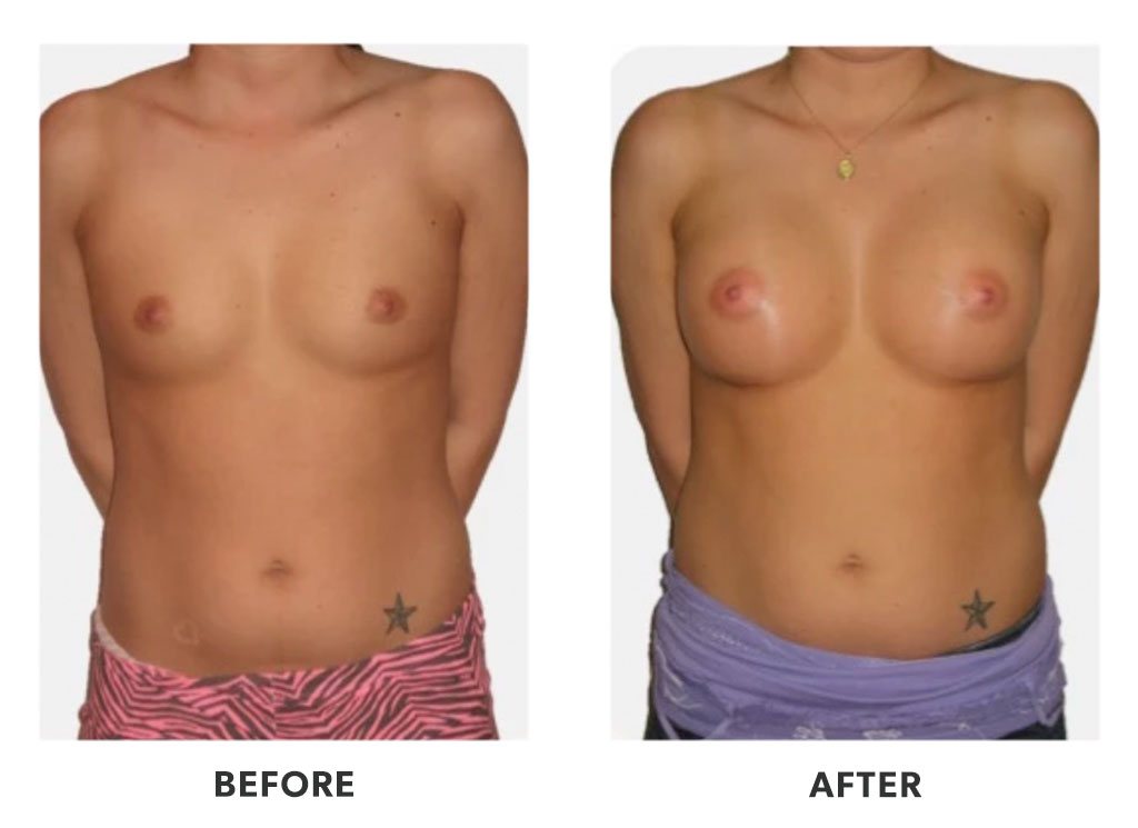 Before and after a breast augmentation in Tijuana Mexico