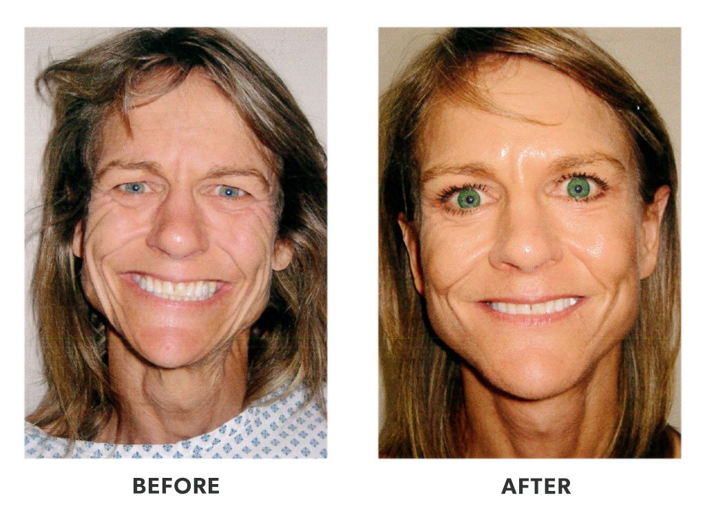 Before and after plastic surgery facelift