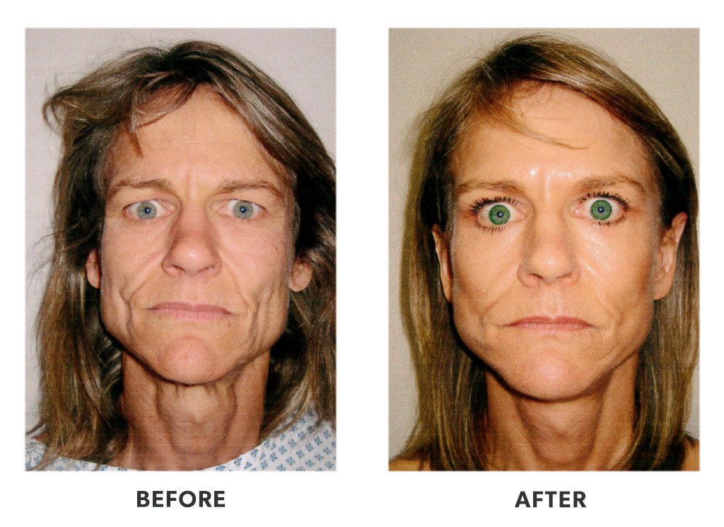 Before and after plastic surgery facelift