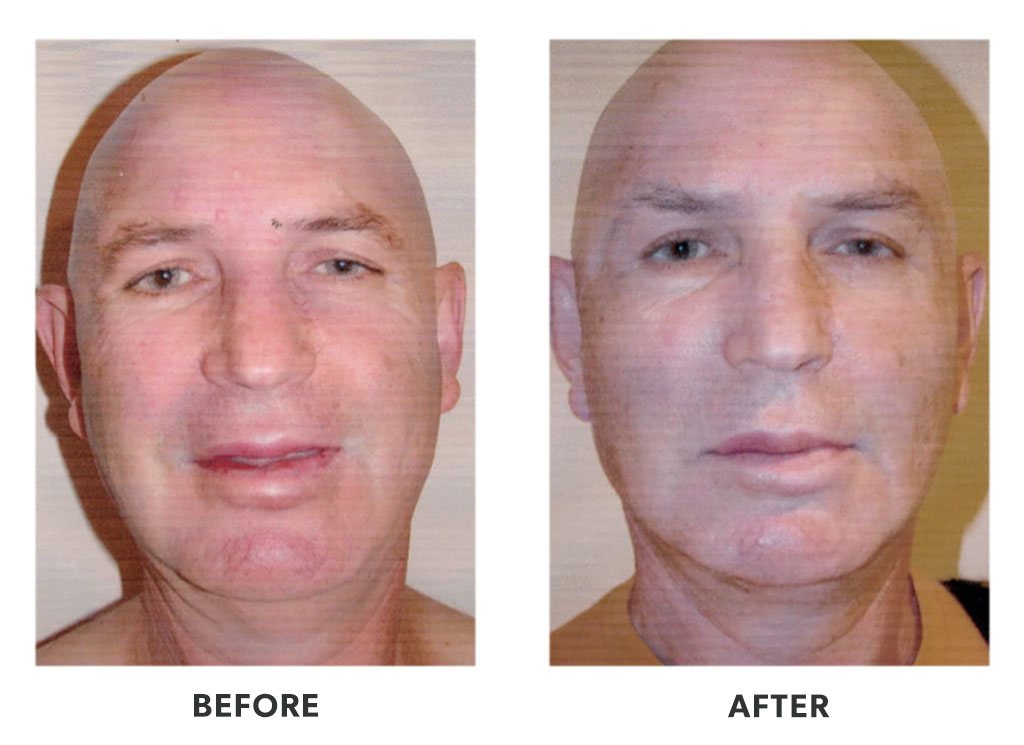 Before and after plastic surgery facelift