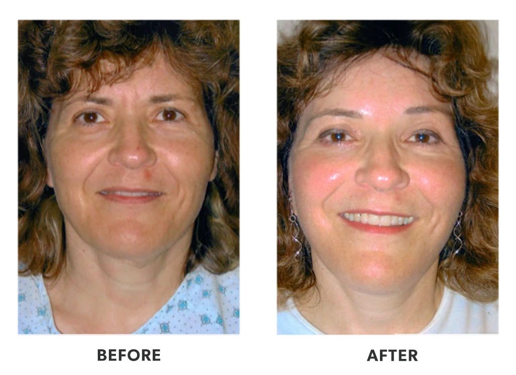 Before and after plastic surgery facelift