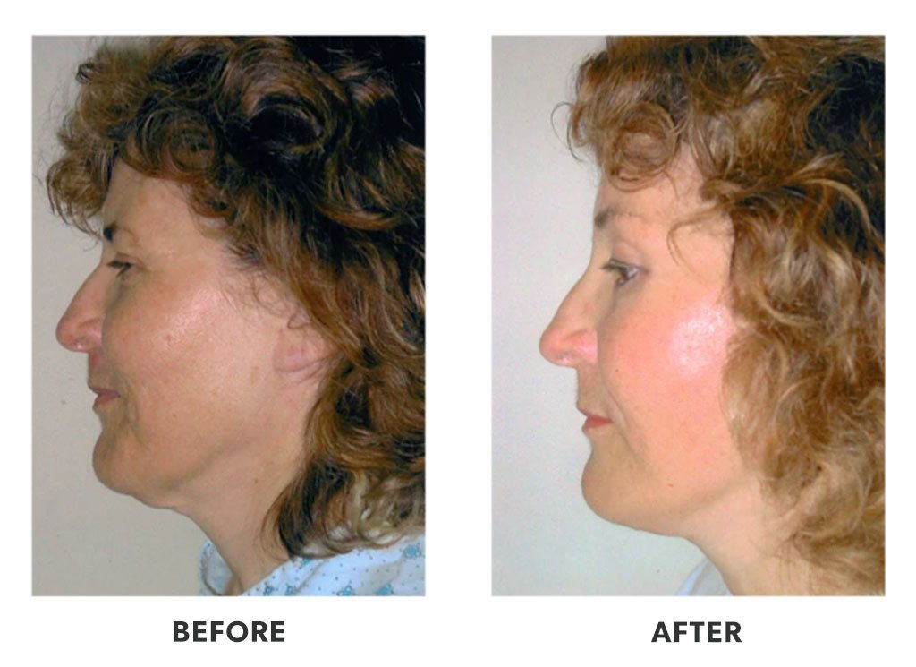 Before and after plastic surgery facelift