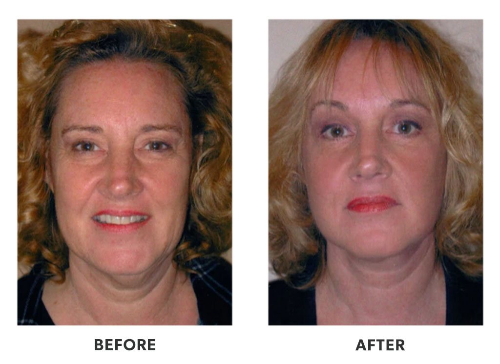 Before and after plastic surgery facelift