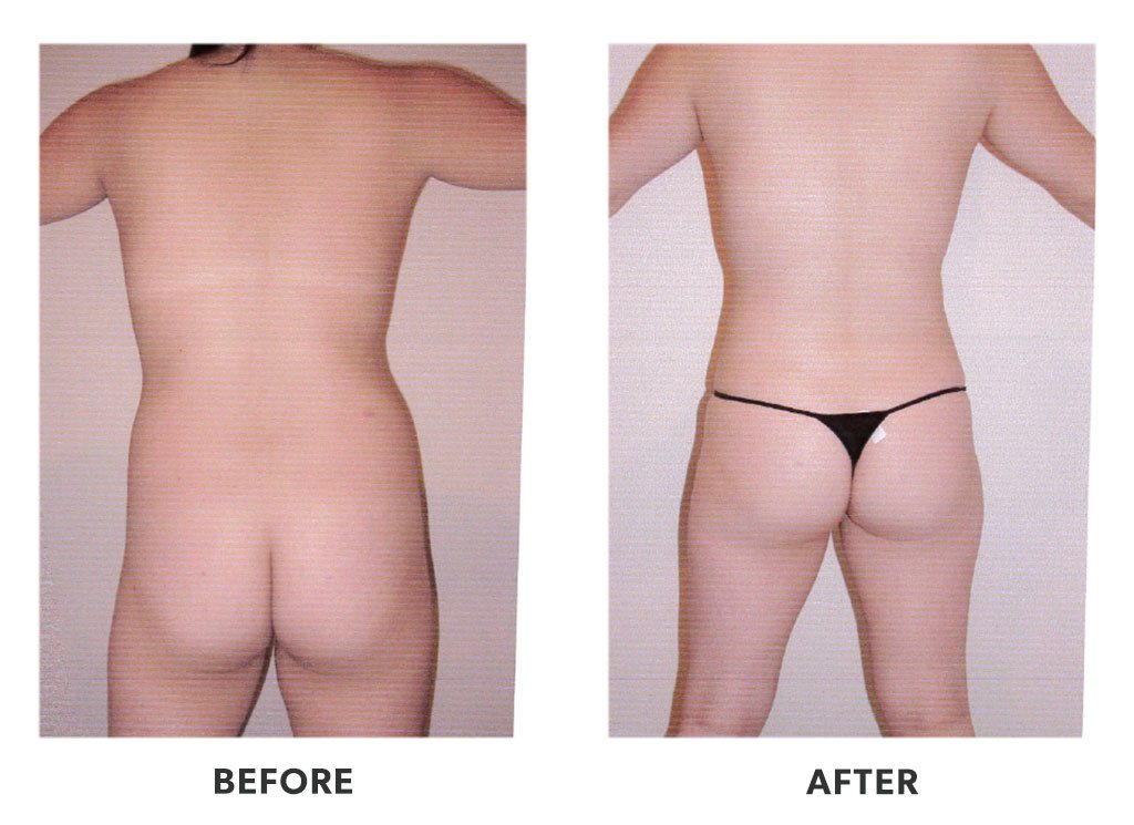 Before and after a liposuction in Tijuana Mexico