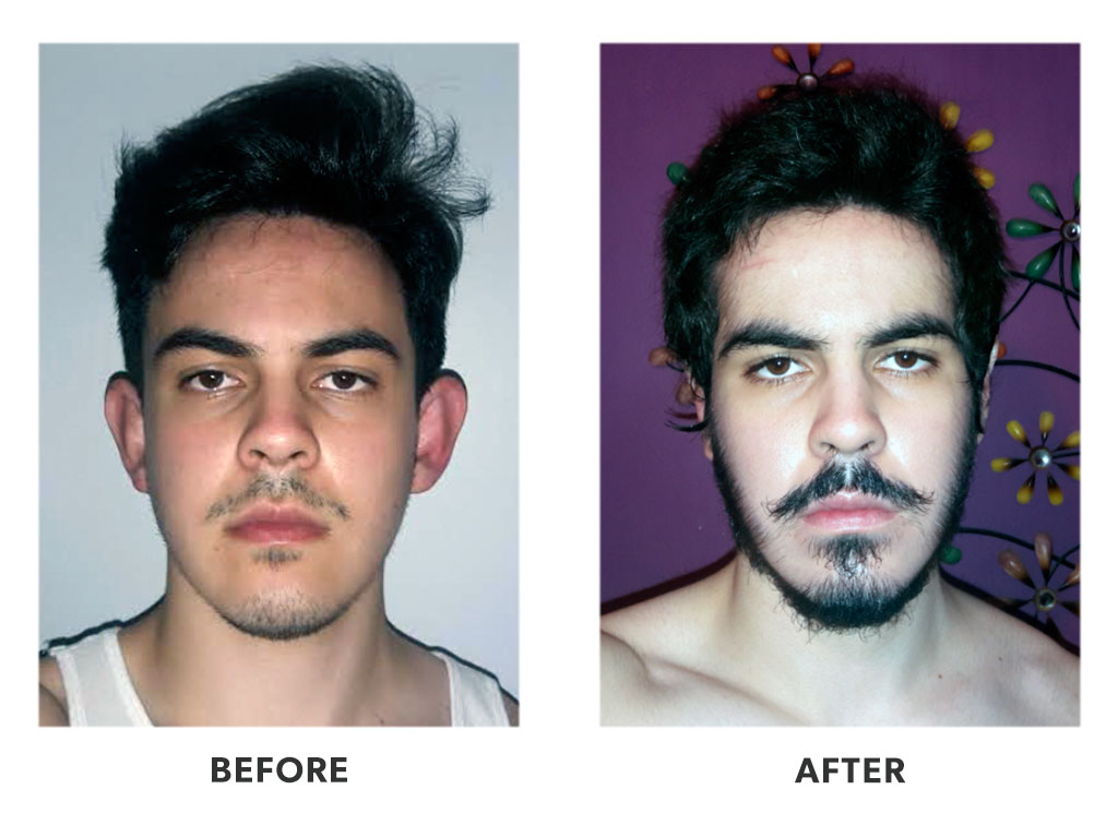 otoplastyprocedure1 Before and after an otoplasty in Tijuana Mexico