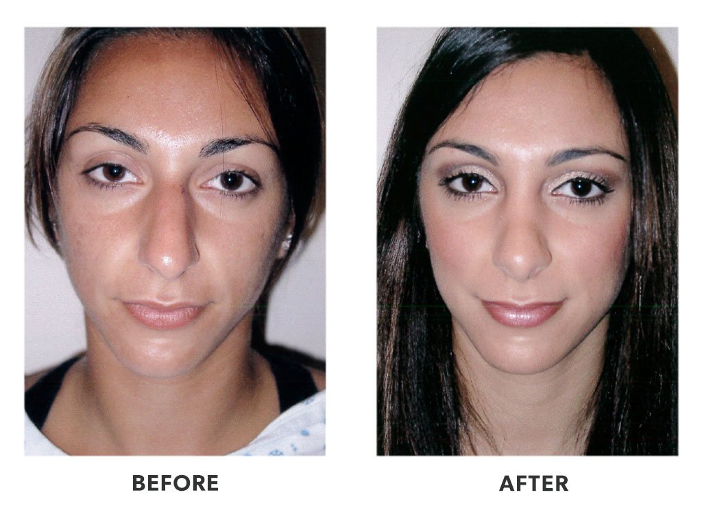 Before and after a rhinoplasty in Tijuana Mexico