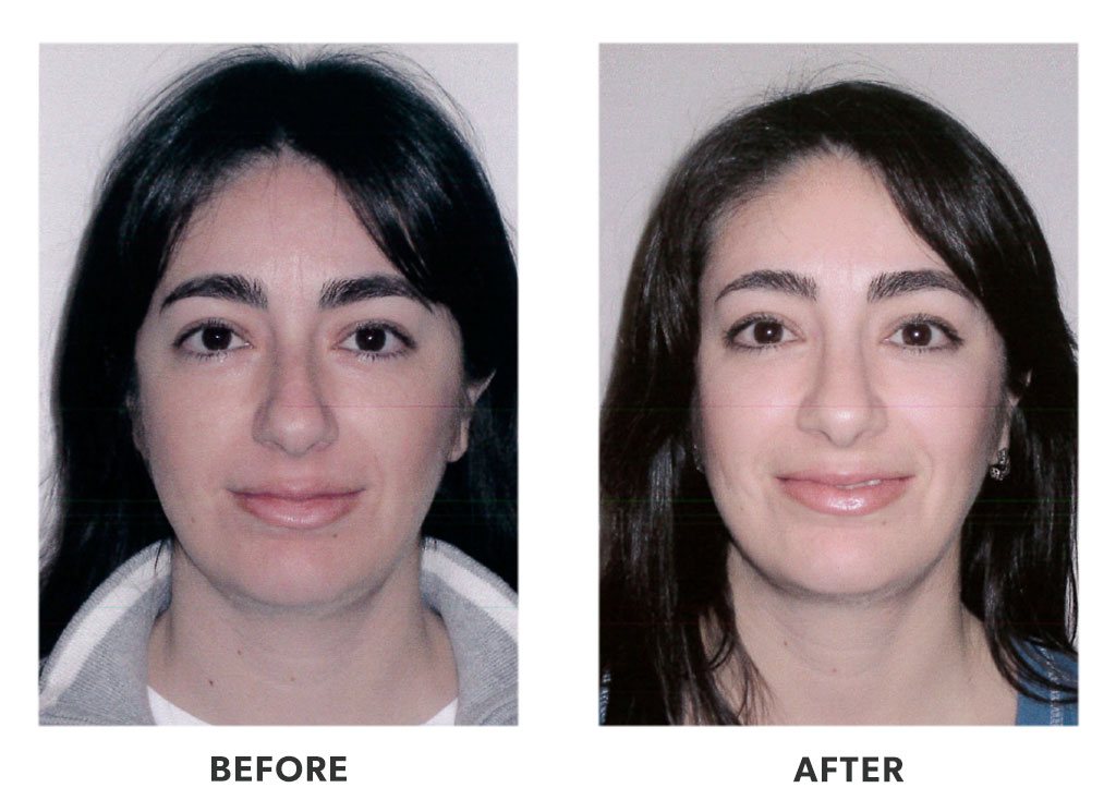 Before and after a rhinoplasty in Tijuana Mexico