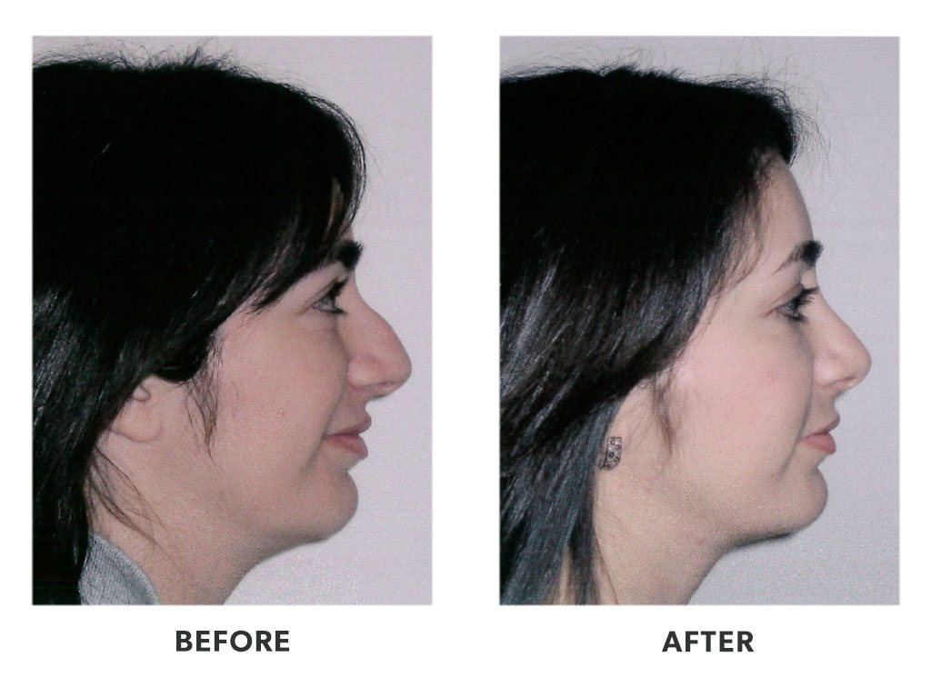 Before and after a rhinoplasty in Tijuana Mexico