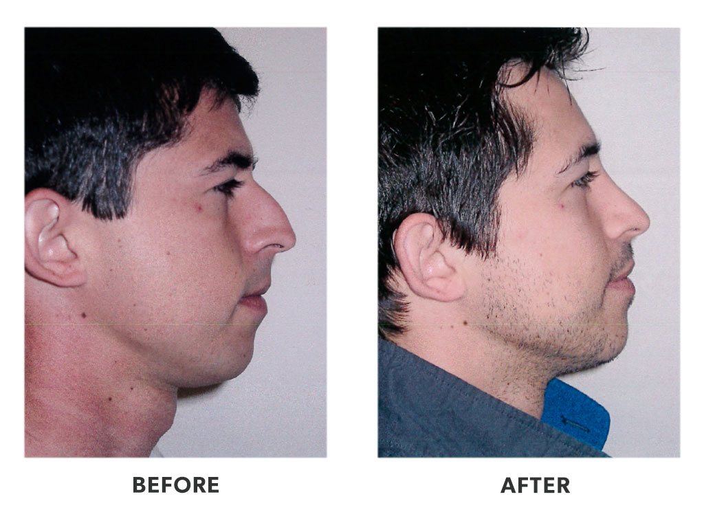 Before and after a rhinoplasty in Tijuana Mexico