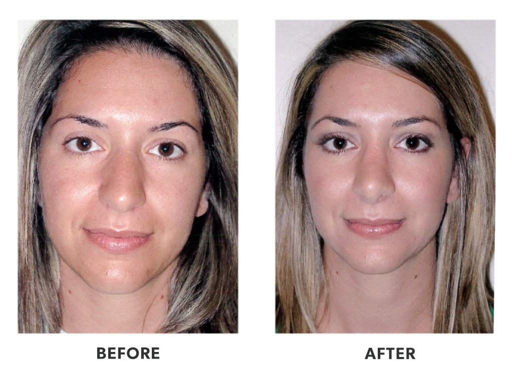 Before and after a rhinoplasty in Tijuana Mexico