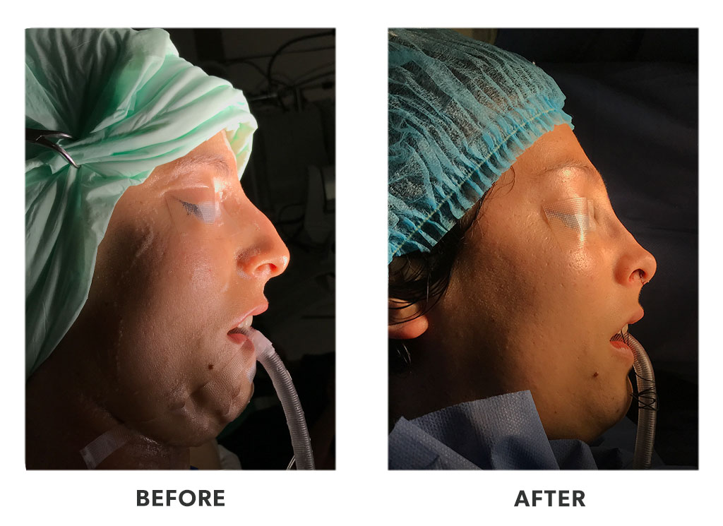Before and after a rhinoplasty in Tijuana Mexico