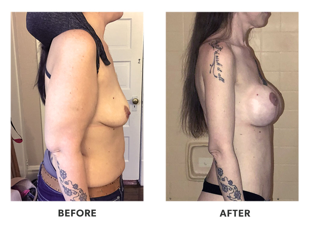 Before and after a tummy tuck in Tijuana Mexico