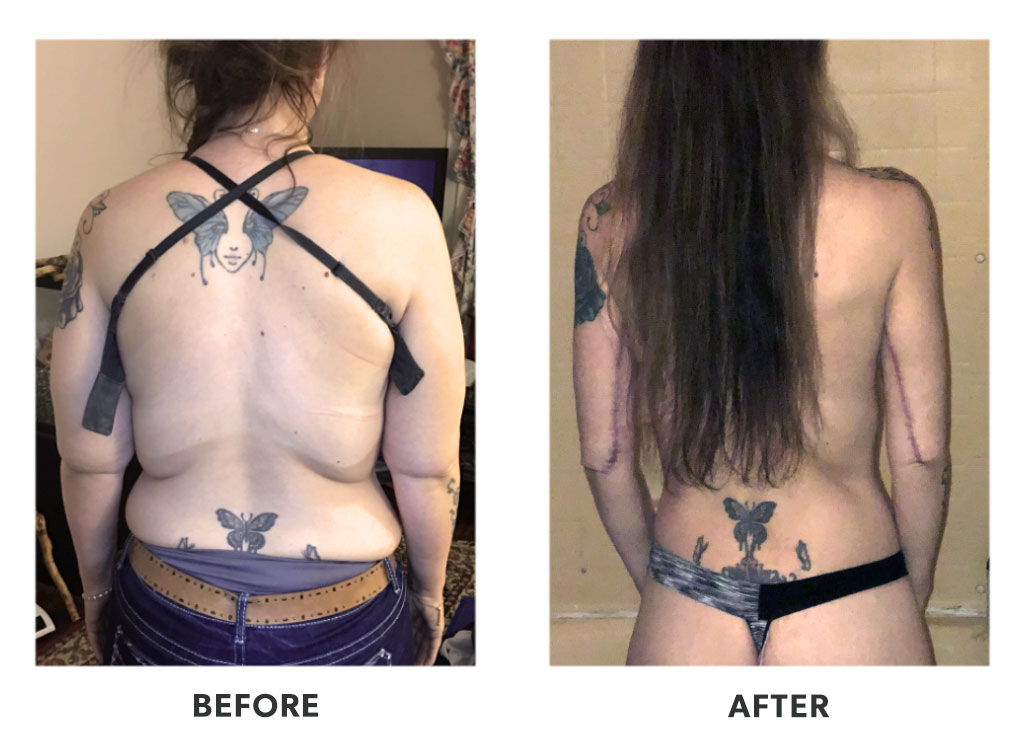 Before and after a tummy tuck in Tijuana Mexico