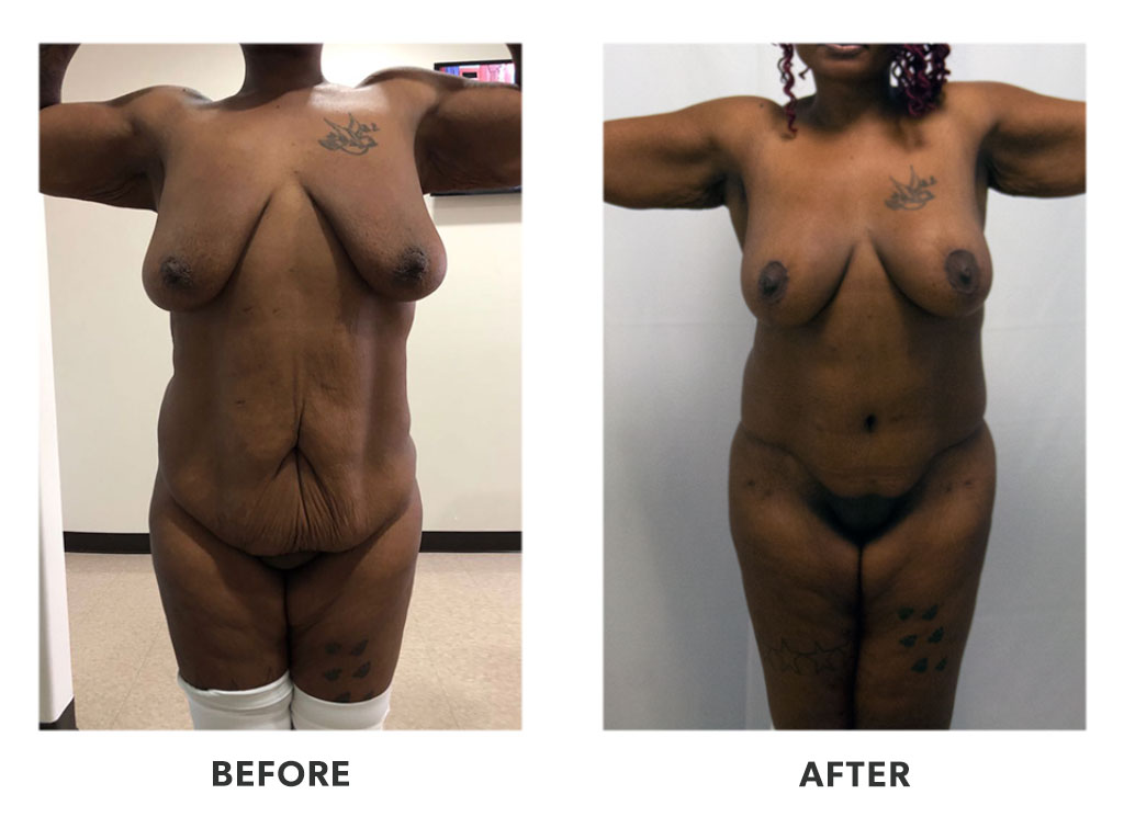 Before and after a tummy tuck in Tijuana Mexico