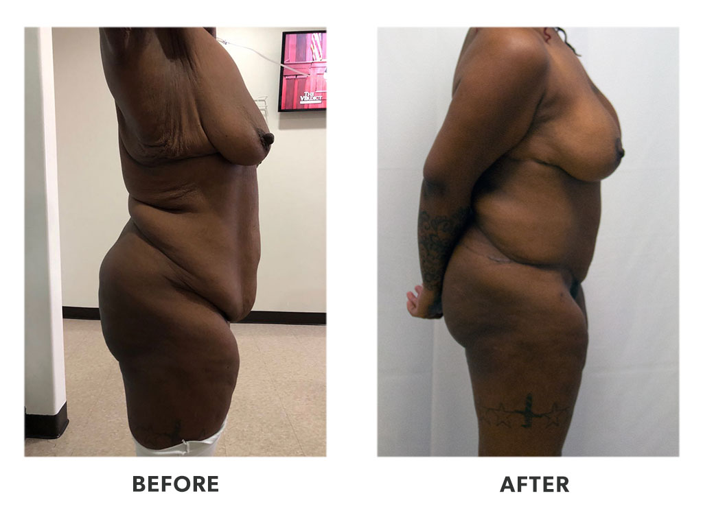 Before and after a tummy tuck in Tijuana Mexico