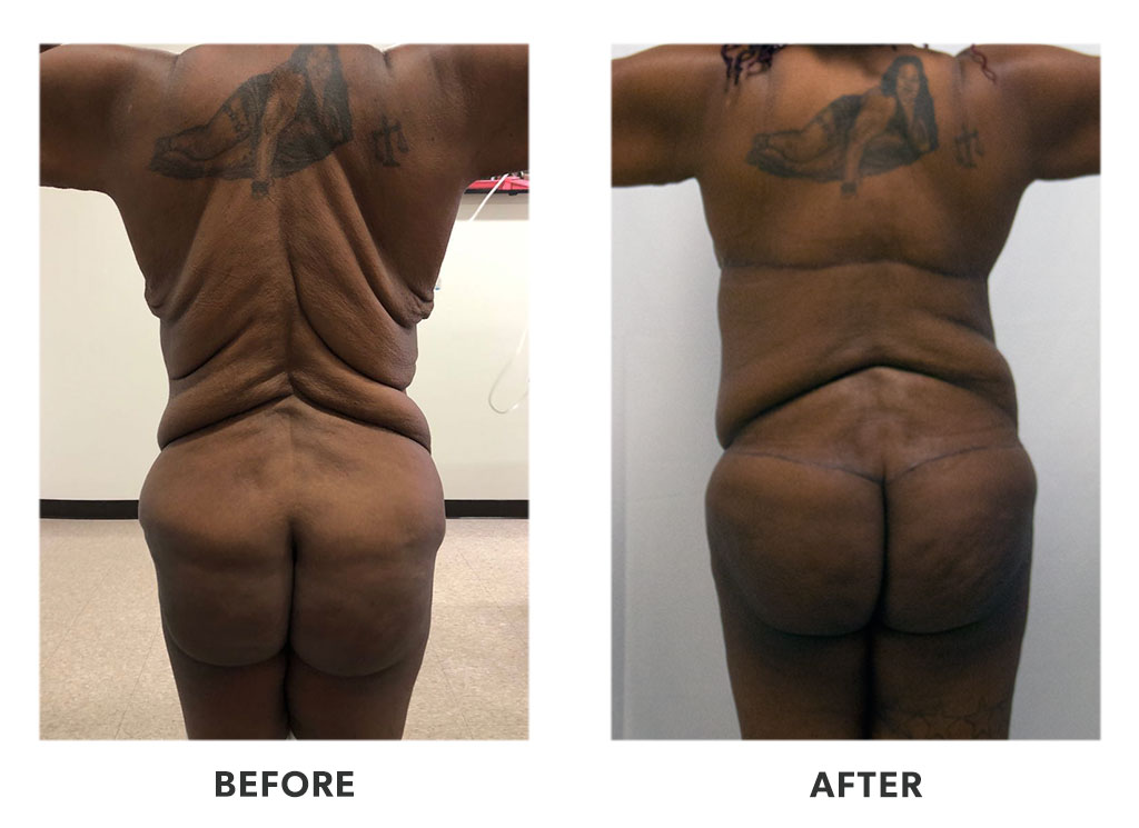 Before and after a tummy tuck in Tijuana Mexico