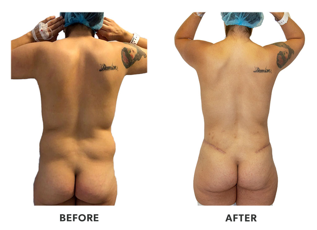 Before and after a tummy tuck in Tijuana Mexico
