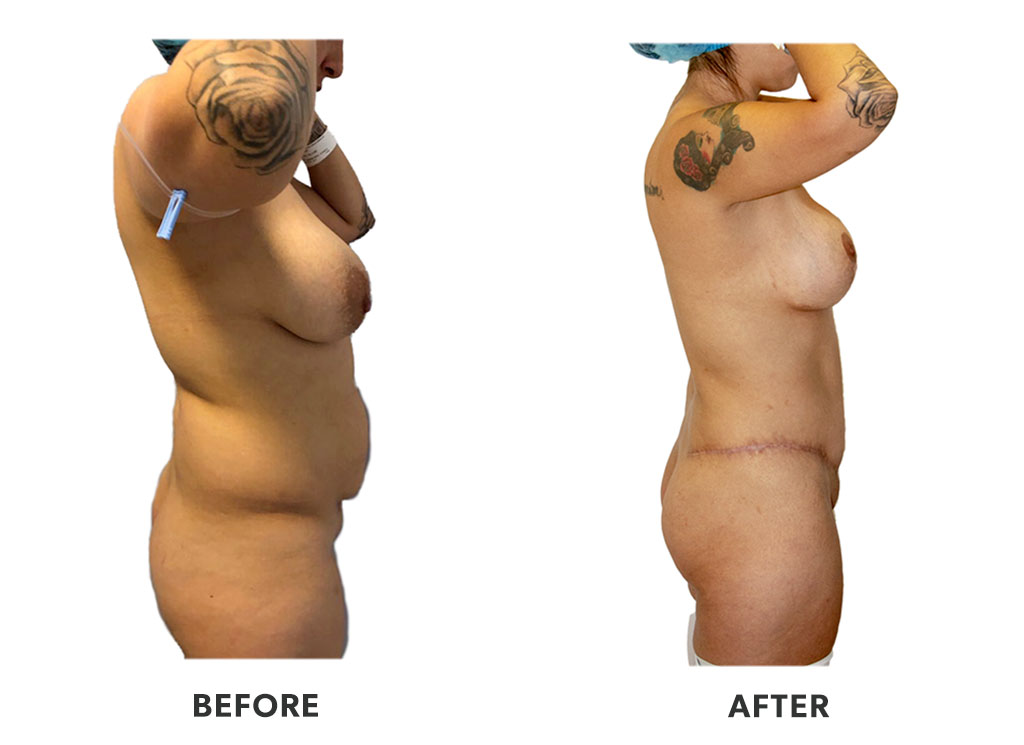 Before and after a tummy tuck in Tijuana Mexico