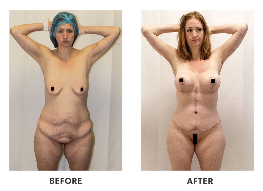 Before and after a tummy tuck in Tijuana Mexico