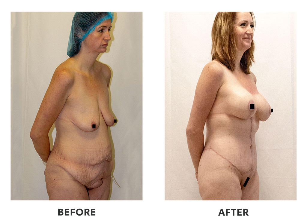Before and after a tummy tuck in Tijuana Mexico