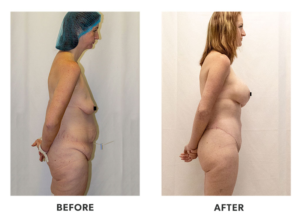 Before and after a tummy tuck in Tijuana Mexico