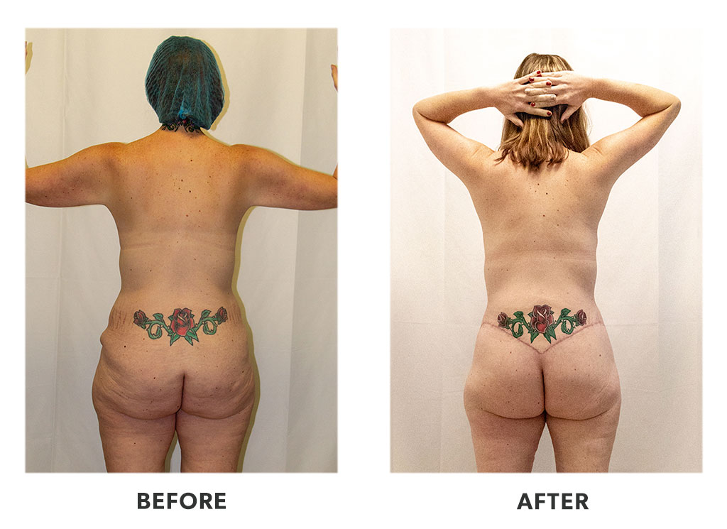 Before and after a tummy tuck in Tijuana Mexico