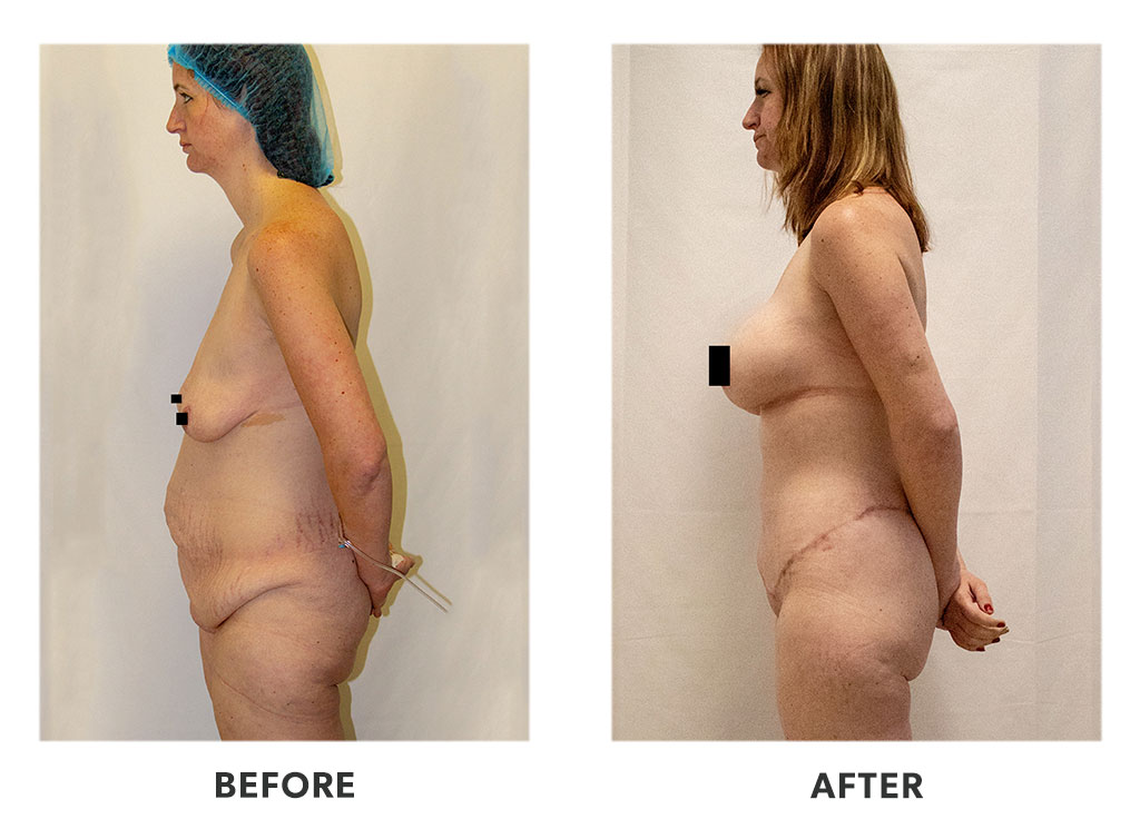 Before and after a tummy tuck in Tijuana Mexico