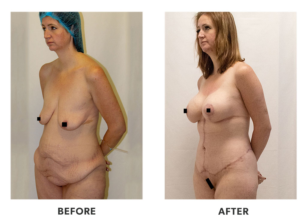 Before and after a tummy tuck in Tijuana Mexico