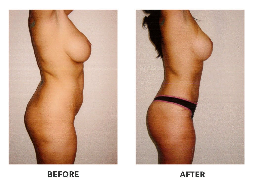 Before and after a tummy tuck in Tijuana Mexico