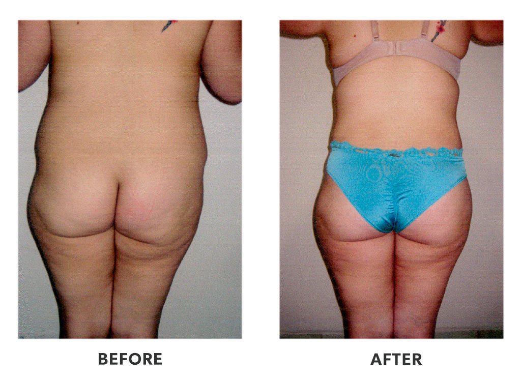 Before and after a tummy tuck in Tijuana Mexico