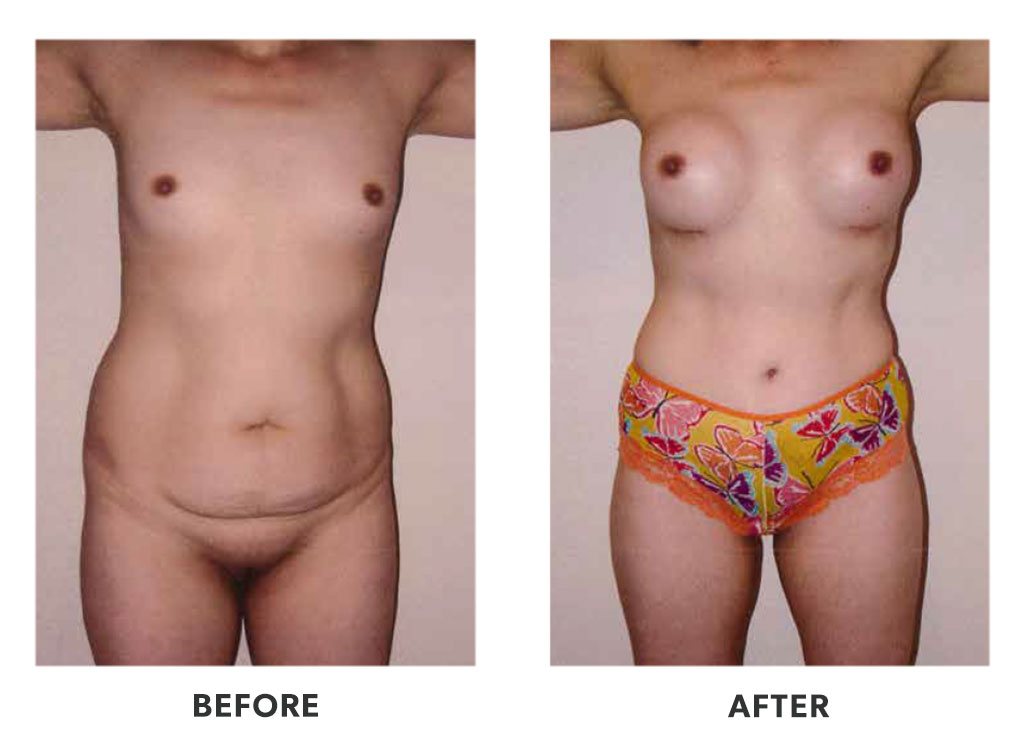 Before and after a tummy tuck in Tijuana Mexico