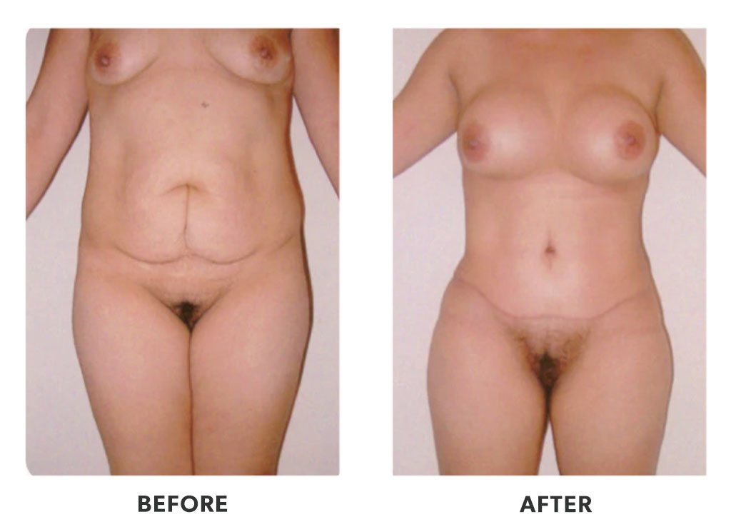 Before and after a tummy tuck in Tijuana Mexico