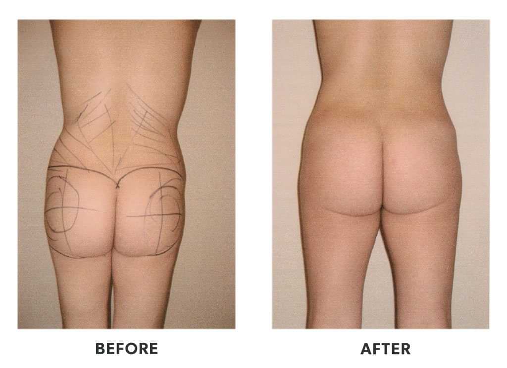 BBL Mexico patient in Tijuana, before and after