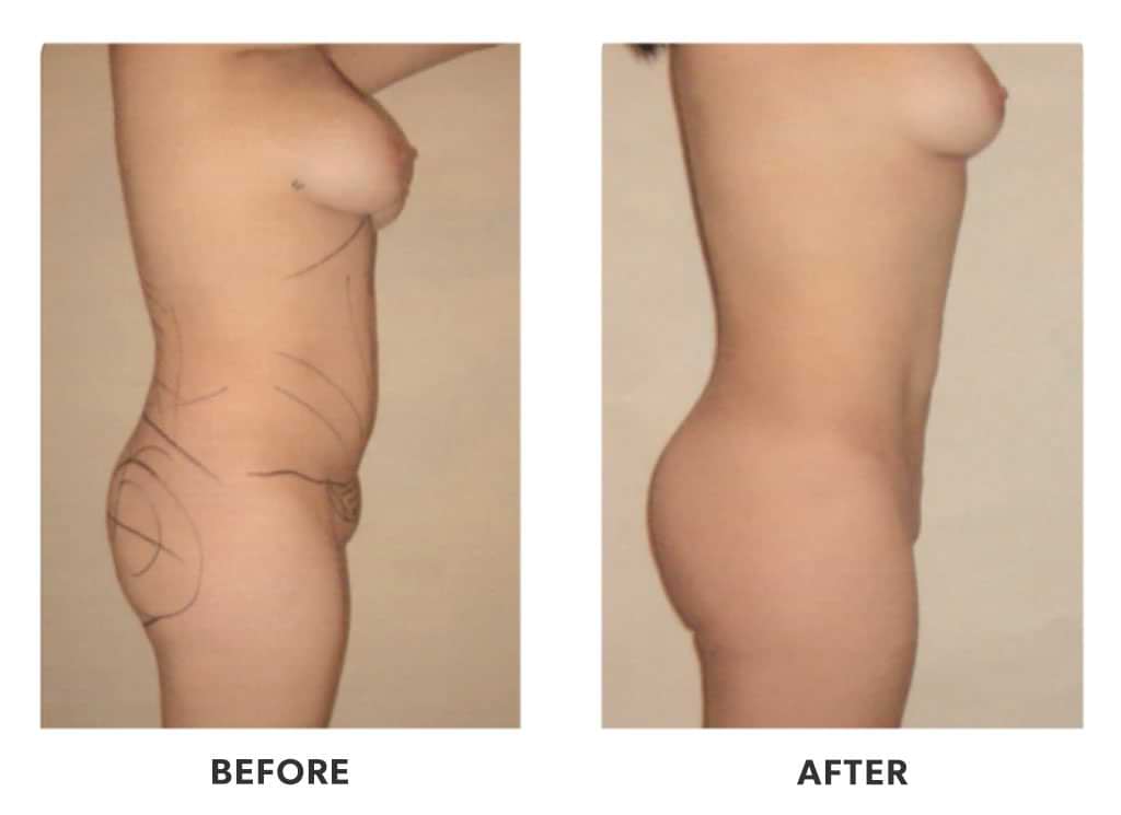 BBL in Tijuana Mexico, patient after surgery