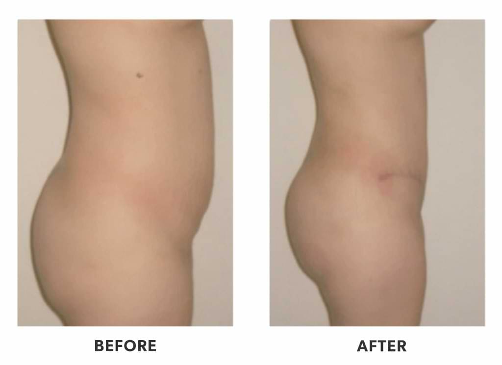 Lipoinjection patient after a Brazilian butt lift